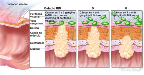 Tratamiento del cáncer de colon (PDQ®)