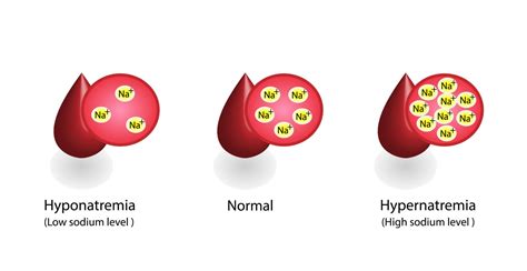 Does Low Sodium Indicate Kidney Problems? - Durham Nephrology Associates, PA