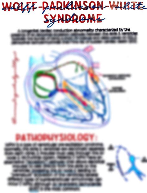 Wolff parkinson white syndrome – Artofit