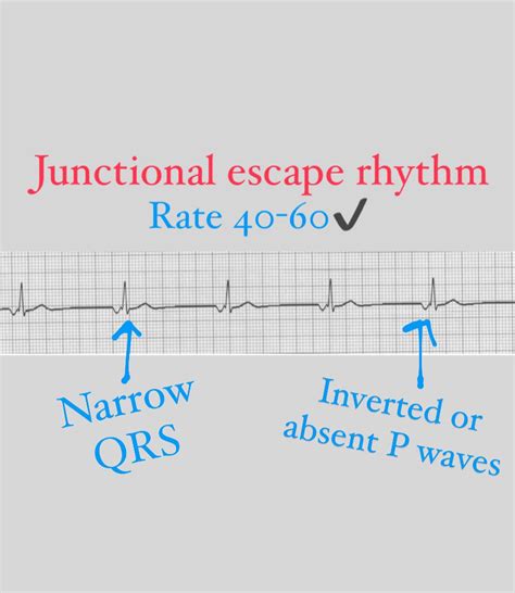 Junctional Escape Rhythm