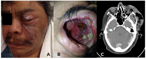 Fungal Invasive Co-Infection Due to Aspergillus fumigatus and Rhizopus ...