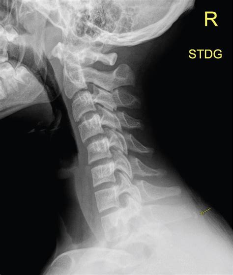 Thoracic Spinous Process Fracture Treatment