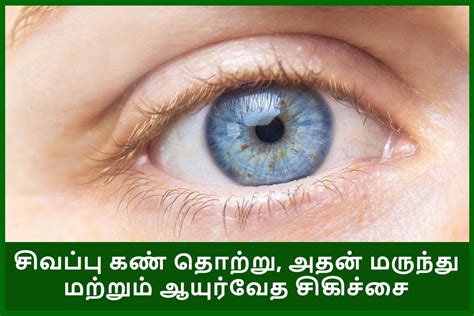 Red eyes infection, its medicine and treatment in ayurveda