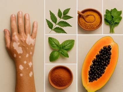 सफेद दाग ठीक करने का घरेलू उपाय, अपनाएं ये 6 टिप्स, धीरे-धीरे दिखने ...