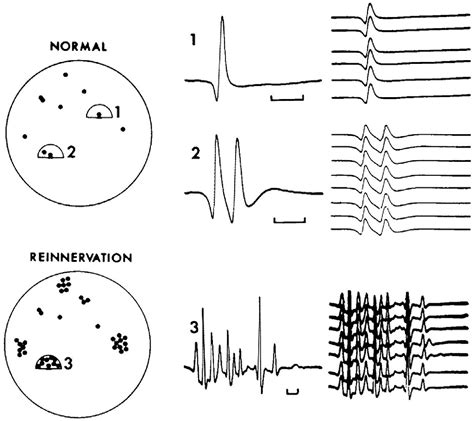 Image result for Single Fiber EMG Test