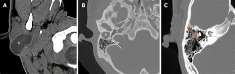 First branchial cleft cyst accompanied by external auditory canal ...