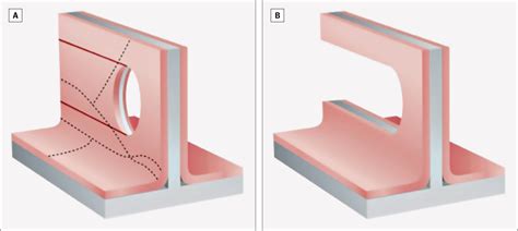 Image result for Resection Using a Straight Edge Examples