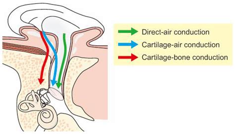 Cartilage Conduction Hearing and Its Clinical Application