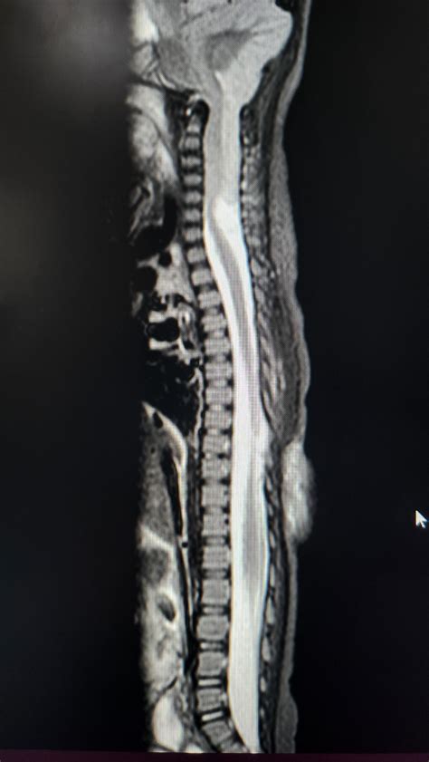 Chiari Type II in a 1 year old. : r/Radiology