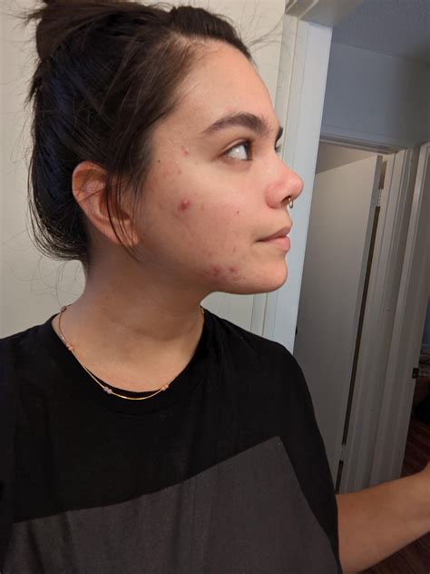 I'm getting so frustrated with my skin. The adapalene is working and I know it just takes time ...