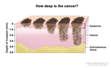 How Fast Does Melanoma Grow