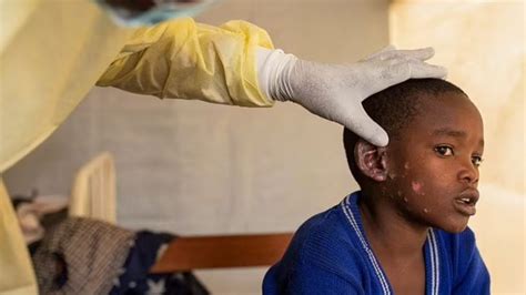 WHO has declared mpox a global health emergency. What happens next?