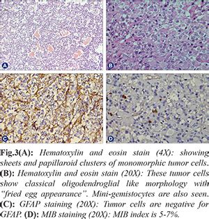 Corpus Callosal Oligodendroglioma: A rare entity
