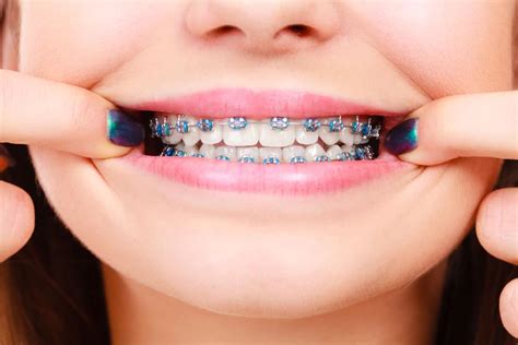 Image result for braces