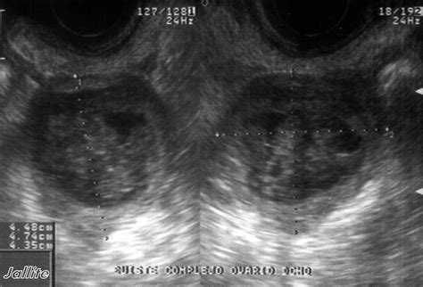 Quiste Ovario Complejo