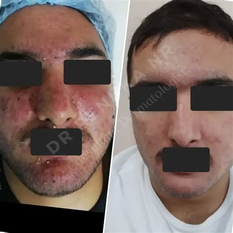 Clear Your Skin! Acne & Pimple Treatment in Kothrud Pune by Dr. Renuka ...