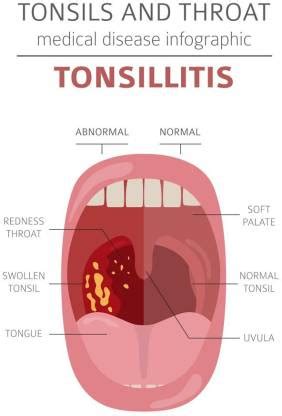 ENT Posters ,Diseases of Ear, Nose and Throat Middle Ear Infections ...