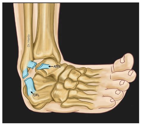 Surgical Treatment of Acute Ankle Injury | Encyclopedia MDPI
