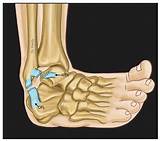 A Review of Chronic Lateral Ankle Instability and Emerging Alternative ...