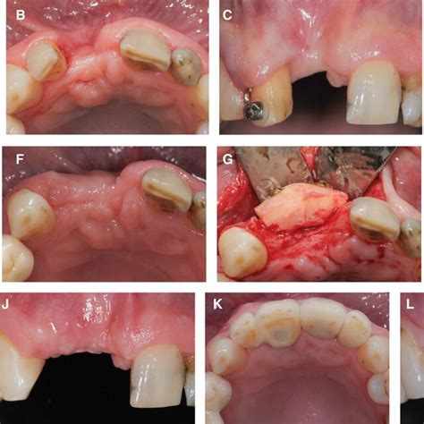 Image result for Tooth Extraction Scar Tissue