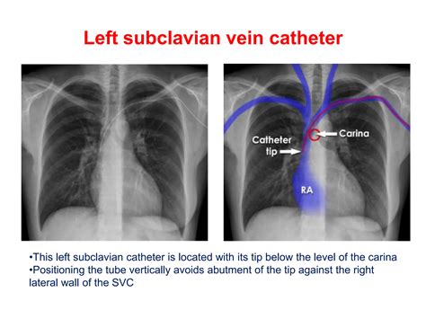 CHEST XRAY TUBES.pptx,,,,,,,,,,,,,,,,,,, | PPTX