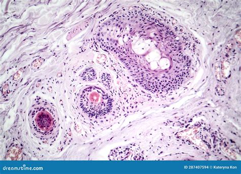 Basal Cell Carcinoma, Light Micrograph Royalty-Free Stock Image | CartoonDealer.com #287407594