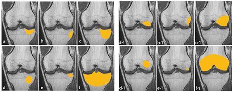 Is Primary Bone Marrow Edema of the Knee Associated with Thyroid ...