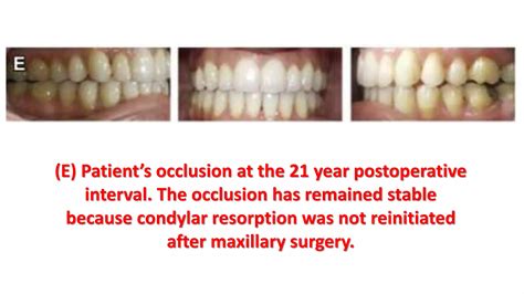 Ortho manage of idiopathic condylar resorption part 1 | PPTX