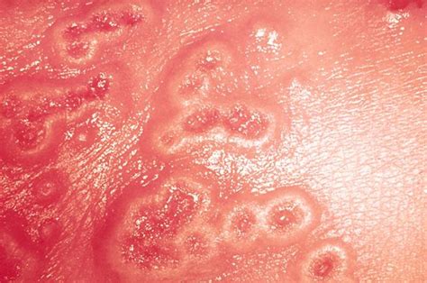 smallpox 的图像结果