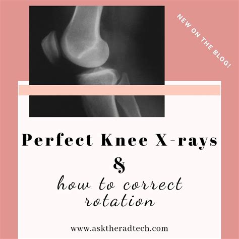 Lateral knee x-ray tips | X ray, Knee, Correction