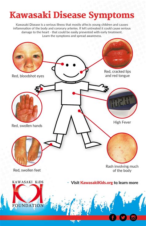 Stages Of Kawasaki Disease at William Behm blog