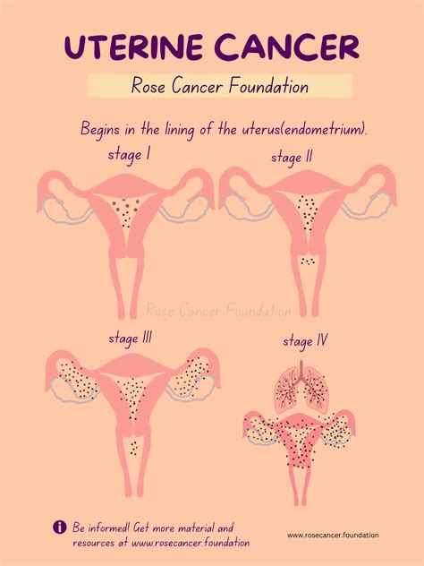 What Is Endometrial Uterine Cancer Symptoms Stages Treatments ...