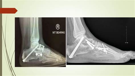 Ankle Arthrodesis.pptx