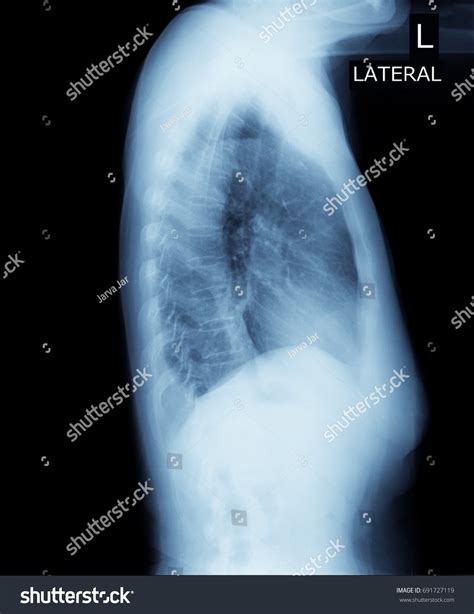 What Is A Decubitus Chest X-Ray at Louise Oliva blog