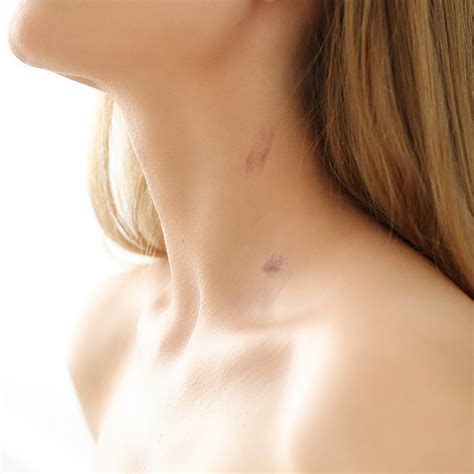 Quick And Easy Ways To Lighten Your Love Bite Marks – bodytales.in