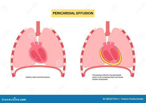 Pericardial Effusion Heart Cartoon Vector | CartoonDealer.com #282705653