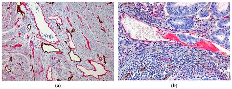 Blood Vessel Invasion Is an Independent Prognostic Factor in ...