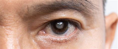 Glaucoma: Symptoms, Causes & More | Fluent Health