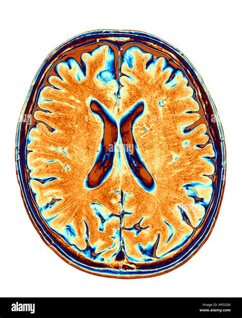 Normal brain mri hi-res stock photography and images - Alamy