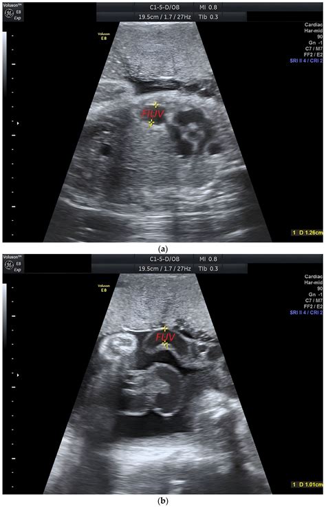 Persistent Right Umbilical Vein: Clinical Case and Literature Review