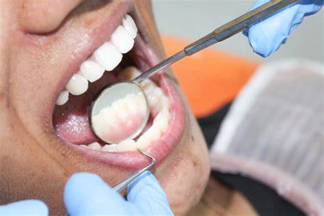 Image result for How to Clean Front Teeth Partials