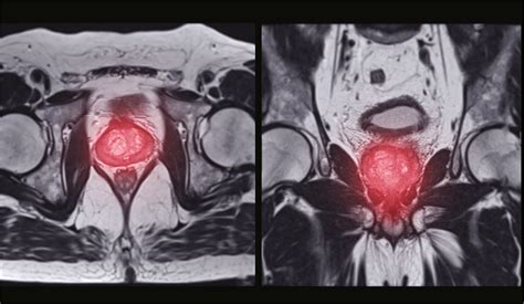 MRI is more accurate than a PSMA PET/CT scan for prostate cancer diagnosis - 2022 - Cancer ...