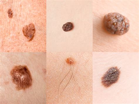 Types Skin Cancer Signs 的图像结果