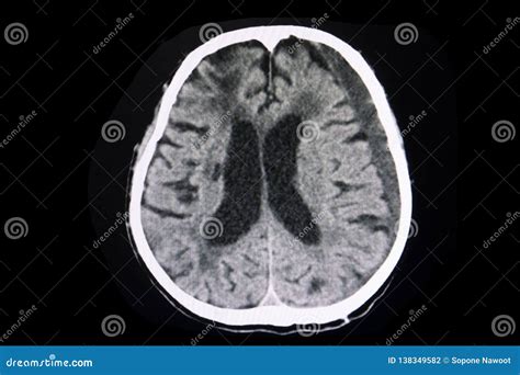 CT Brain Subacute Subdural Hematoma Stock Photo - Image of catastrophic ...