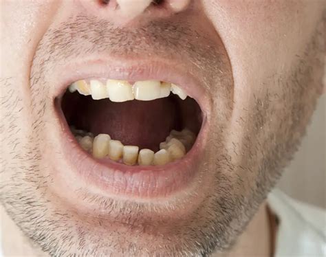 Image result for Teeth Staining Causes