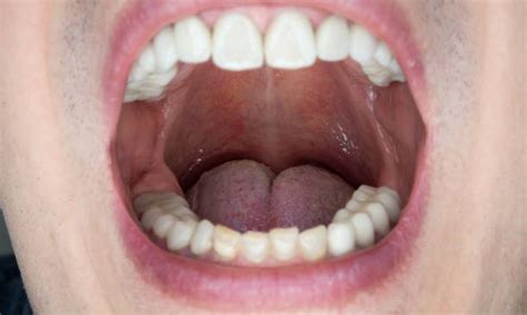 Oral Thrush Before And After