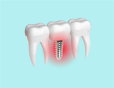 Effective Treatments for Infection Around Dental Implants - Toronto Dental Clinic