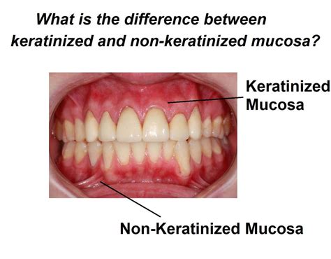 What is the difference between keratinized and non-keratinized mucosa ...
