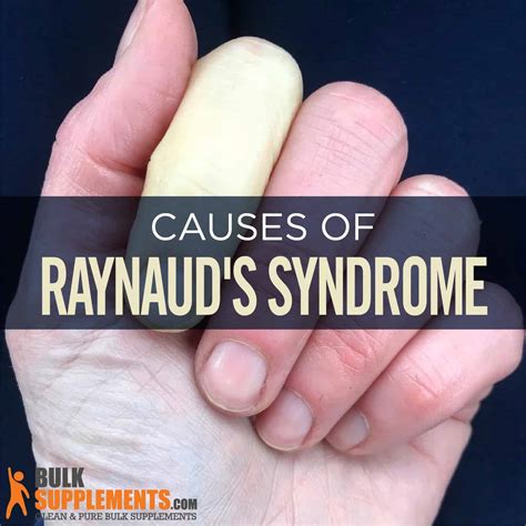 Raynauds Phenomenon Raynaud's Phenomenon (three Color Changes) Of The