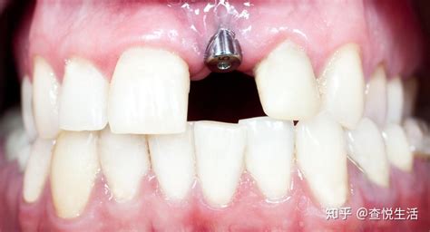 镶牙和种植牙有什么区别？该怎么选？牙科医生一语道破玄机 - 知乎